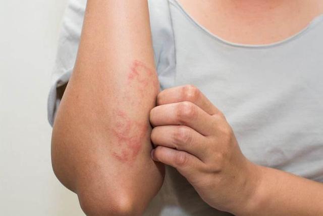湿疹会传染吗? 特应性皮炎和湿疹经常出现在婴儿湿疹,不会传染.
