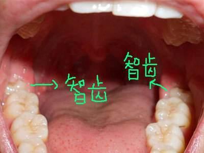 长出来的智齿必须要拔掉吗?看完你就知道了