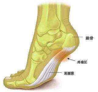 走路时脚后跟总是疼是怎么回事?是缺钙引起的吗?或许与它有关