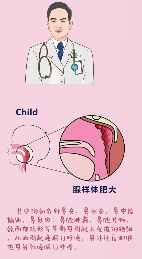 最主要的原因是扁桃体和/或腺样体肥大引起.