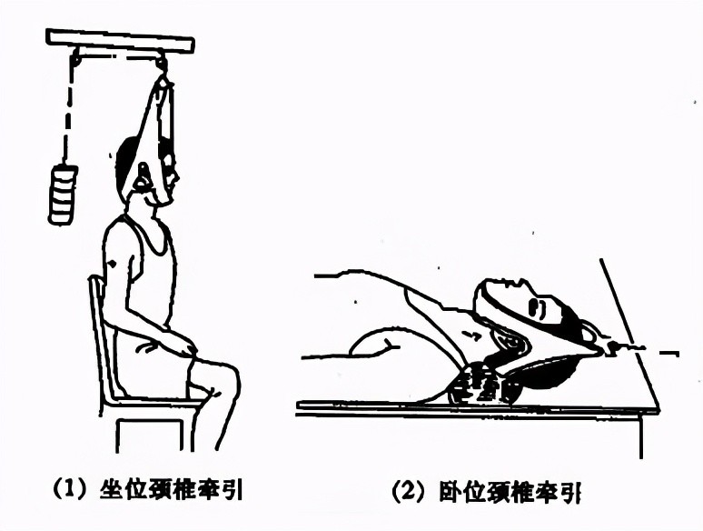 误区五:长期牵引可以治疗颈椎病