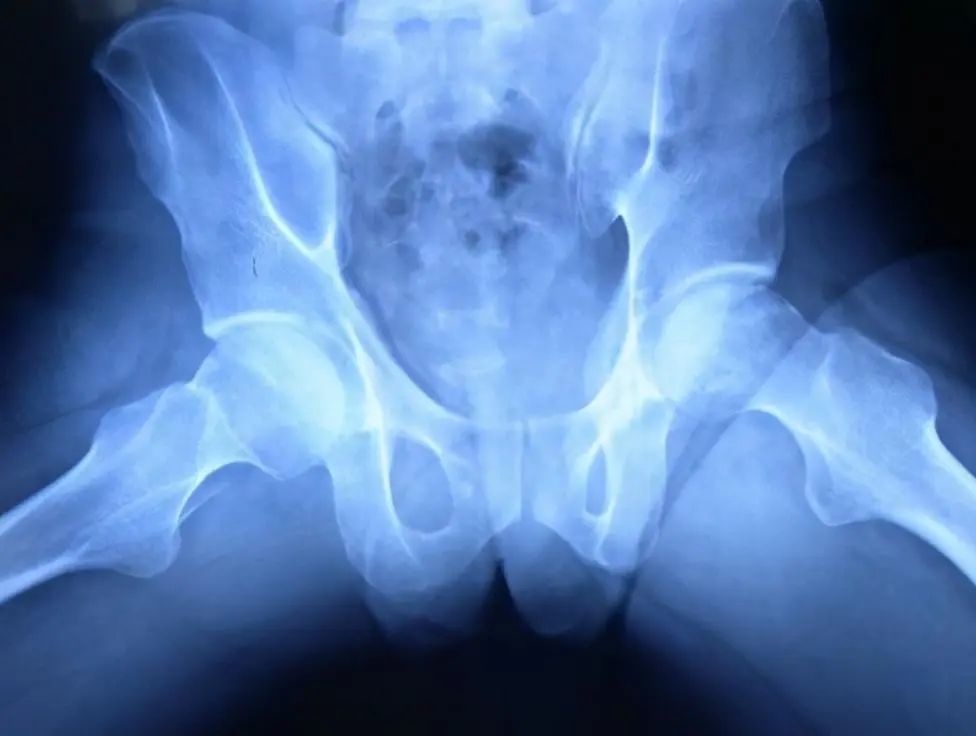 股骨头坏死的4点危害有必要知道