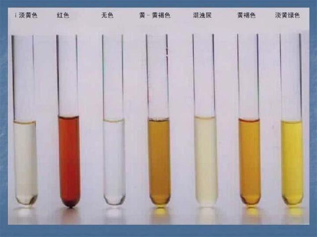 通过观察尿液,或可反应出体内尿酸水平的高低