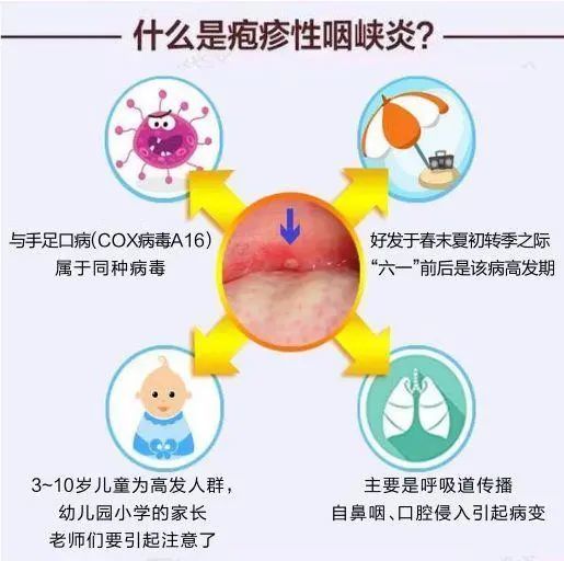 健康科普疱疹性咽峡炎该如何应对