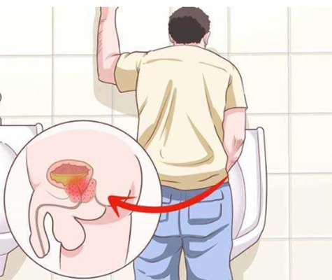 男人知道前列腺炎是什么症状吗?