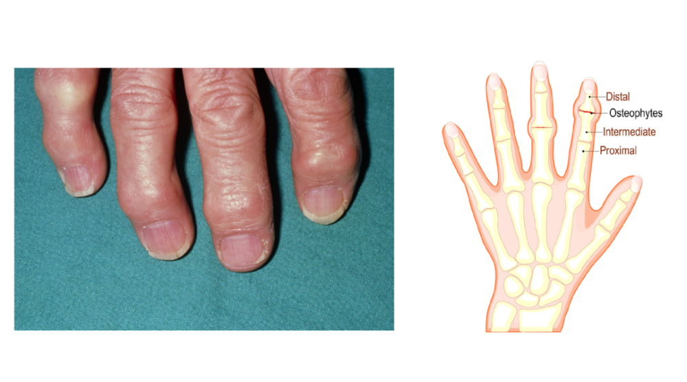 骨关节炎典型表现:手指关节出现结节