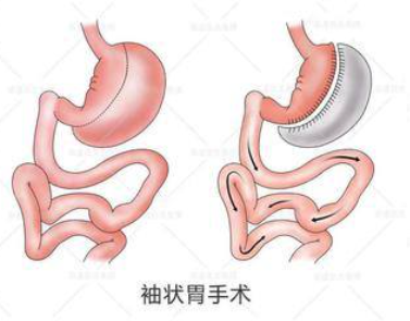 袖状胃切除术超越保赔了1万八第236期