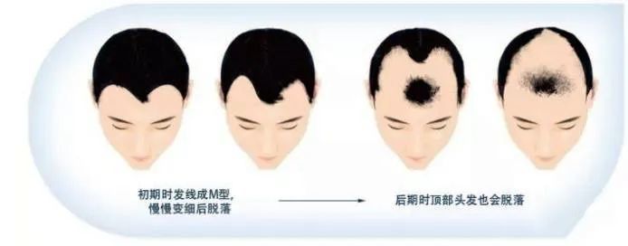 m型脱发是如何一步步走向秃顶的