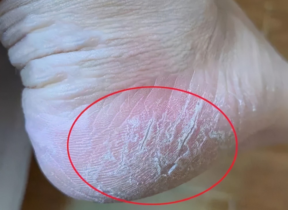 脚后跟经常起皮开裂,是缺乏维生素吗?原因不止一种,对照检查