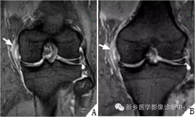 【分级】内侧副韧带损伤的mri分级及图解