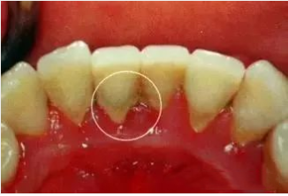 牙周炎十大症状,你中了几招