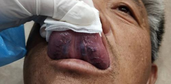 舌下取栓康复法能对哪些症状有调理帮助?多大年龄可以做?
