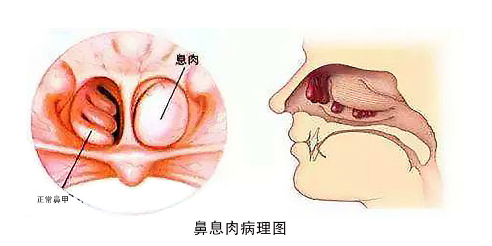 鼻子长息肉还不重视?造成嗅觉失灵引起大麻烦!