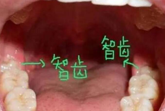 智齿到底应不应该拔掉,三张不需要拔的智齿图片告诉你