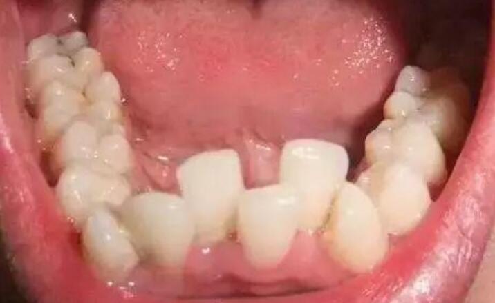不会损害到牙龈,并且可以正常进行咀嚼,那么这种智齿就跟普通的牙齿一