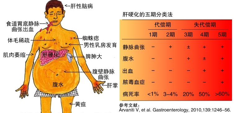 32岁男子,肝硬化入院,提醒:身上若有"2红",及时就医检查