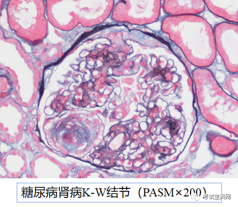 内科学-继发性肾病:糖尿病肾病