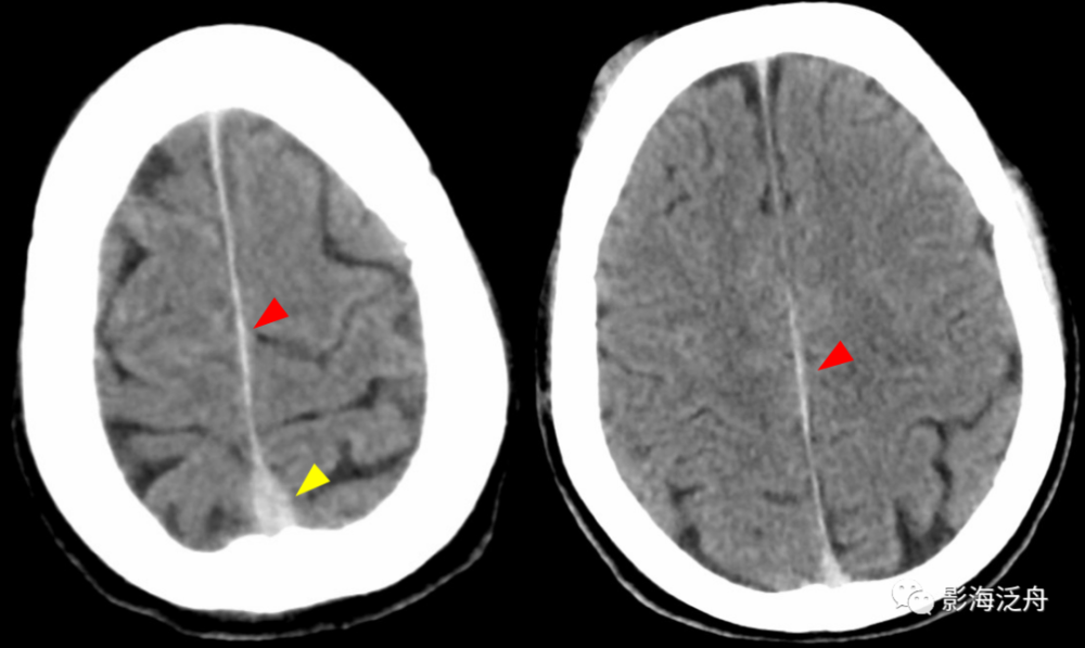 大脑镰旁急性硬膜下血肿与蛛网膜下腔出血的鉴别