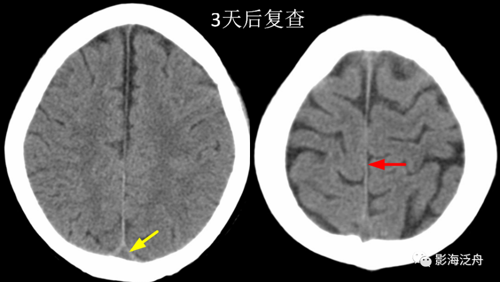 大脑镰或天幕密度增高一定是蛛网膜下腔出血(sah)吗?