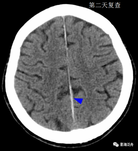 大脑镰旁急性硬膜下血肿与蛛网膜下腔出血的鉴别|硬膜下血肿|sah|血肿