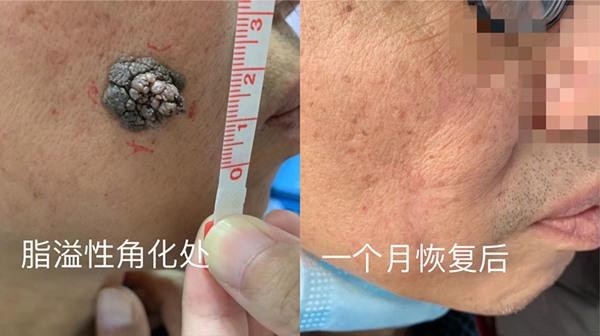 男子频繁生抠硬拽,脸部芝麻小痣半年长至1.5cm大