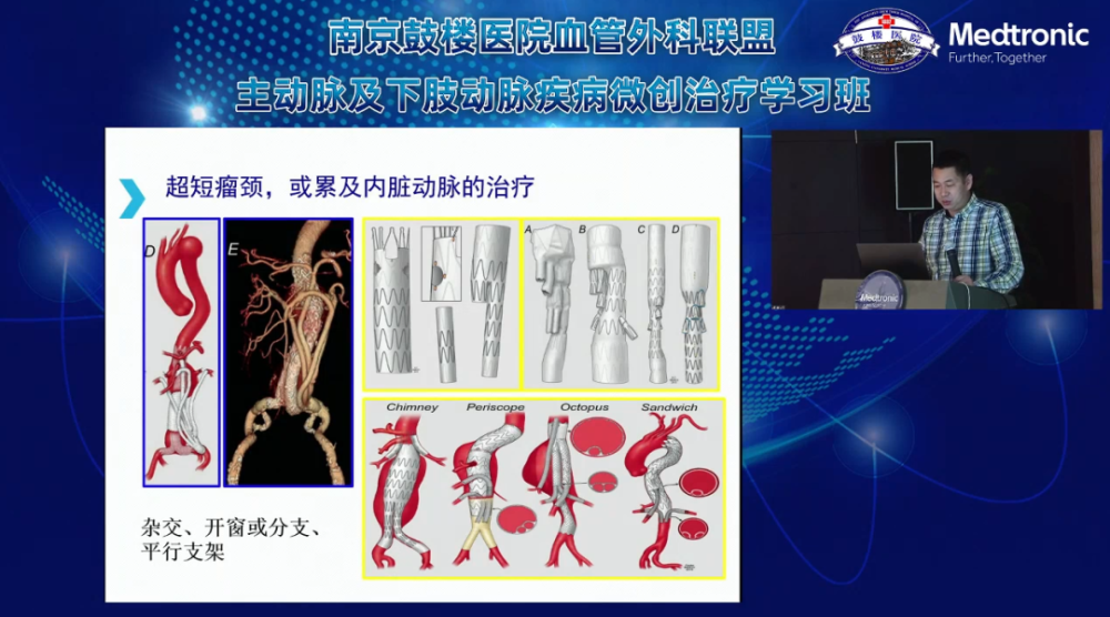 精彩回顾「南京鼓楼医院血管外科联盟」主动脉及下肢动脉疾病微创治疗