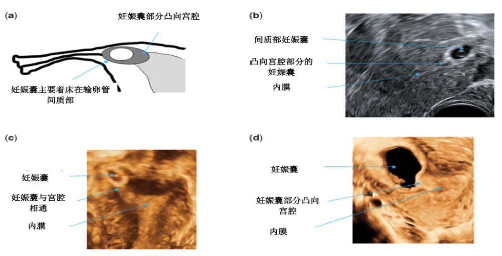 的指南指出,超声诊断输卵管间质部妊娠的关键是妊娠囊至少部分被子宫