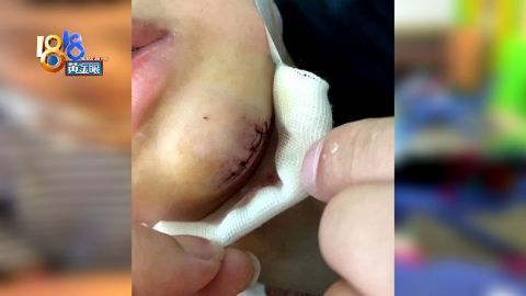 首次体验轮滑课,孩子下巴磕破缝六针,妈妈急了