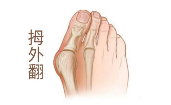 我的大脚趾怎么越来越歪?