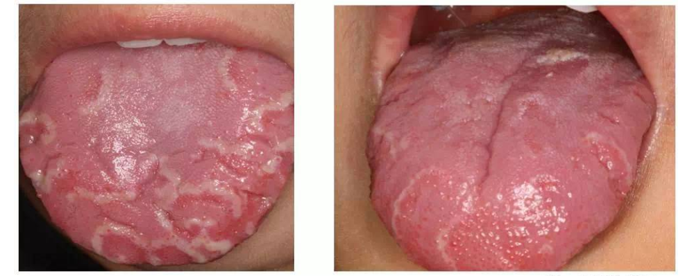 其病损的形态和位置多变,又被称为游生性舌炎,任何年龄都可能发病,但