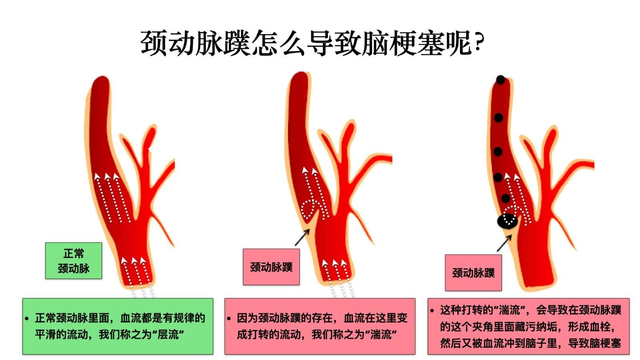 颈动脉发生堵塞,哪个部位反应强烈?希望看完后对你有所帮助