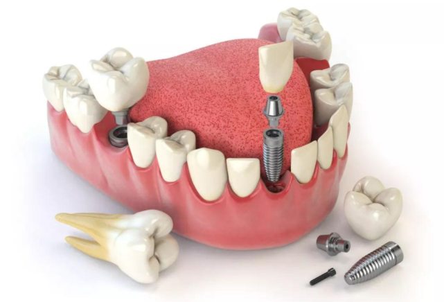 案例1:单颗或多颗缺失牙以最终修复为目标,适用于各类型种植案例