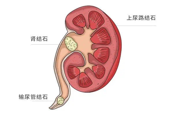 肾结石很大也可无症状 肾结石要怎么处理?