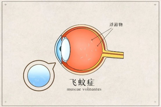 眼睛看到有黑点漂浮物?上海眼科专家这样解释,千万别大意