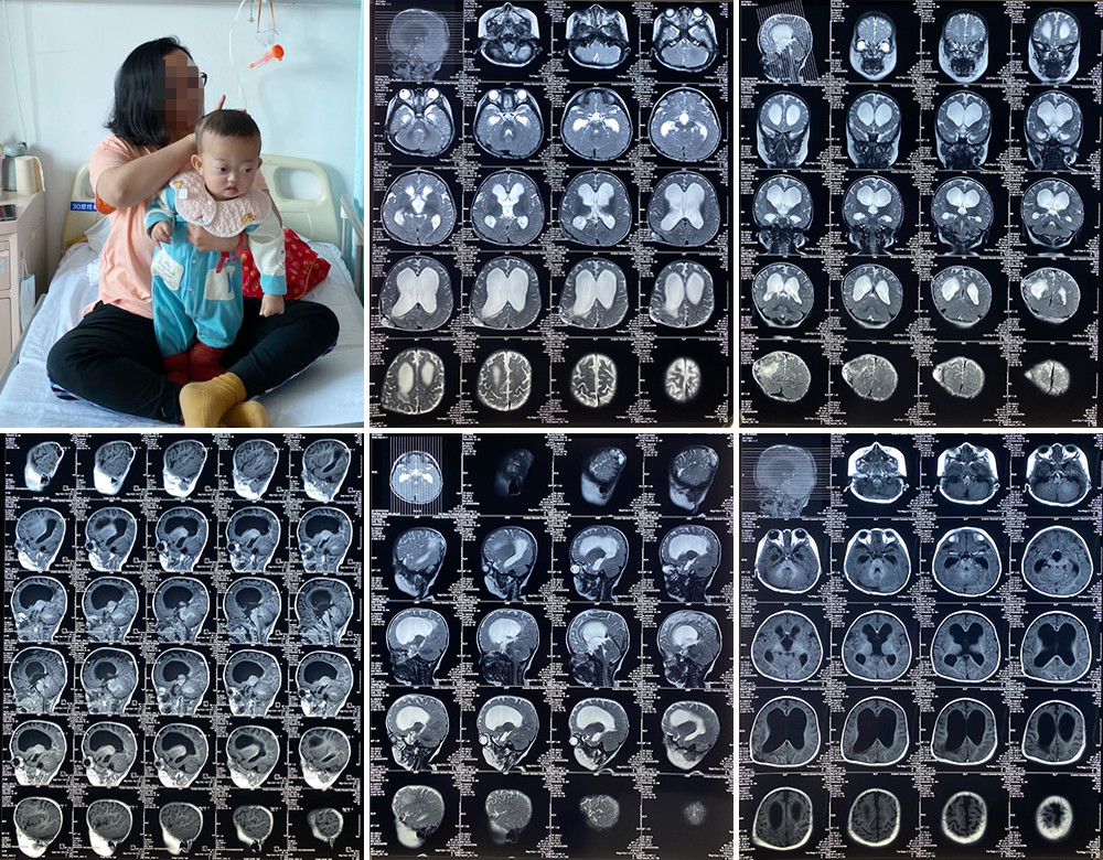 肖庆病例分享:八月龄脑积水幼儿,重获健康