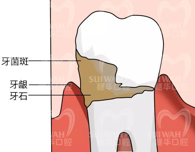 为什么牙结石会长在牙龈下面?