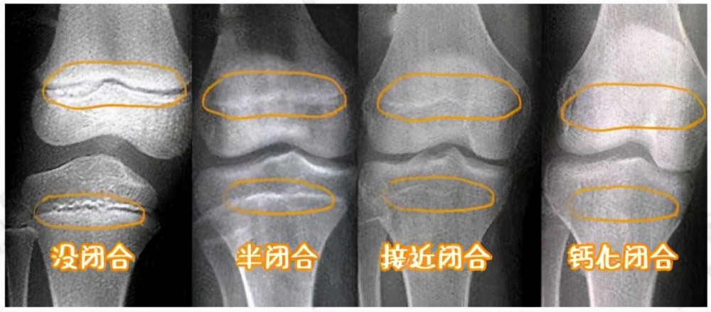 哪些因素会影响孩子长高该如何促进孩子长高医生仔细讲一讲