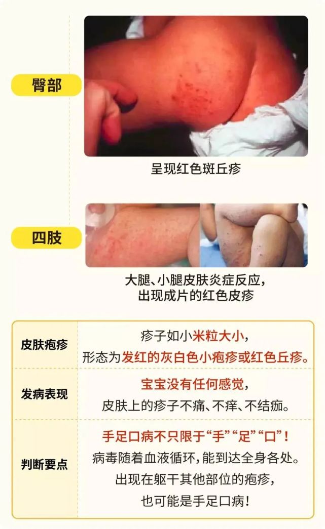 手足口病来势汹汹,已进入高发期!预防记住这些要点