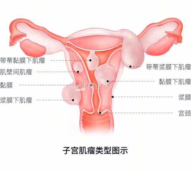 长在子宫肌壁间或是凸向子宫内膜的肌瘤(黏膜下肌瘤)可能会导致怀孕