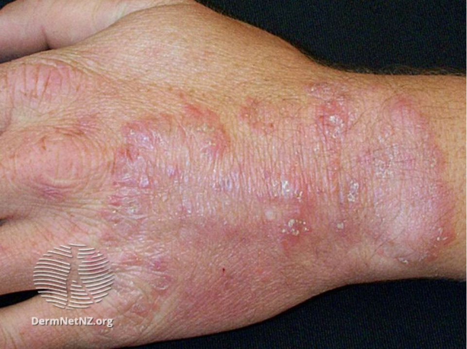 手癣一般是由真菌感染所导致,而这个真菌大多都是从脚气感染来的.