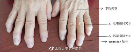 一般情况下,类风湿关节炎最常见肿痛的关节是近端指间关节,掌指关节和