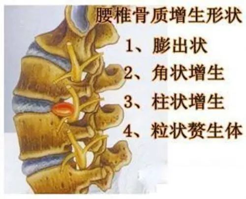 骨质增生大致分为两种,轻度的叫骨质增生,重度的叫骨刺.