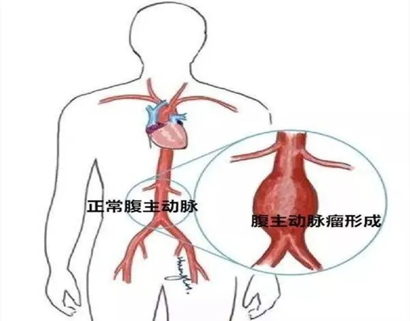 跟着心脏一起跳动的"不定时炸弹"—腹主动脉瘤!该如何