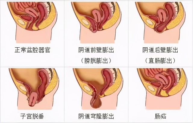 子宫,肠子,膀胱…都可能"掉?这类女性需注意啦!