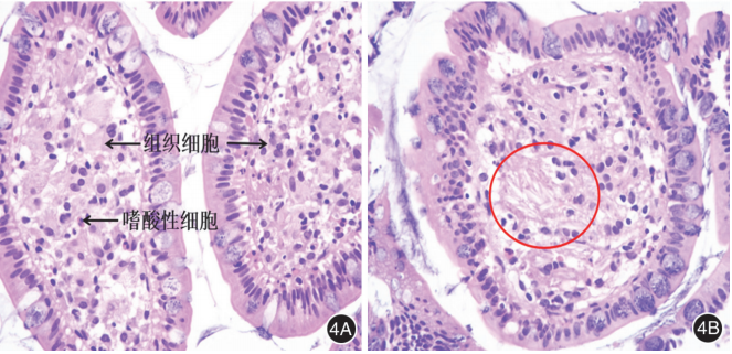 致小肠损伤者的回肠活检病理 he×400 4a:黏膜固有层内见较多组织细胞