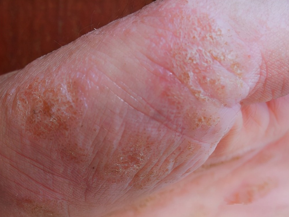 汗疱疹的特征 汗疱疹的特征也是十分明显的,一开始是手足等部位的