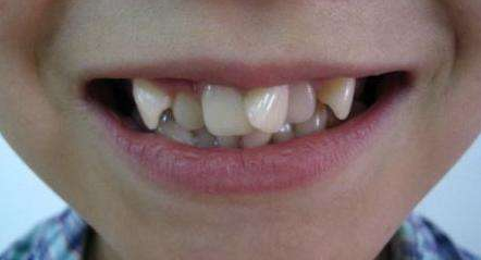 孩子的牙齿出现问题了,需要马上解决,不要等换完牙?