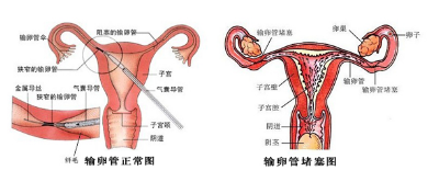 输卵管究竟是一侧堵还是双侧均堵,以及找出具体的堵塞部位,则效果不佳