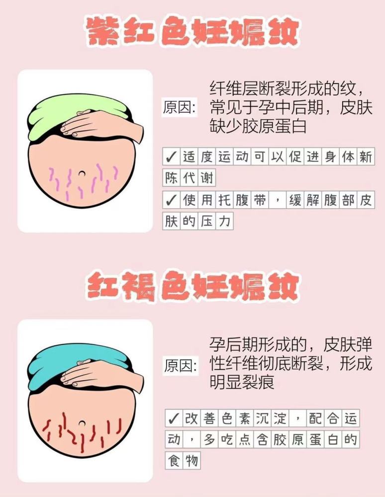 各种颜色妊娠纹知识解答及预防淡化方法!
