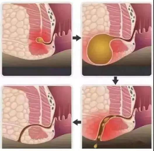 夏季一肛周脓肿多发季节!警惕肛周脓肿侵袭